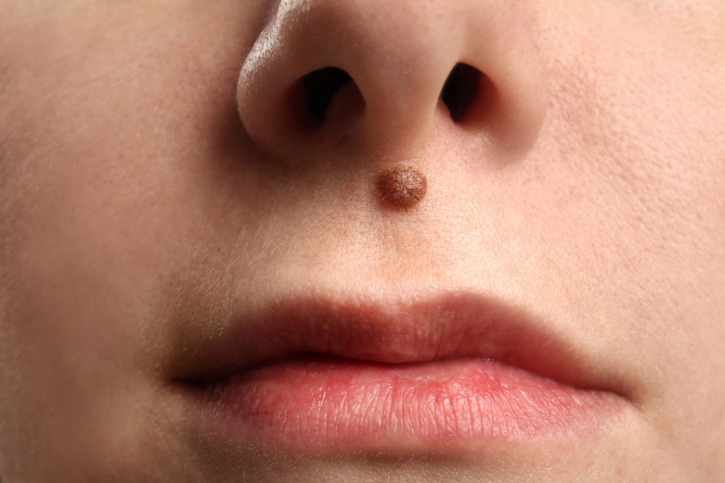 moles removal