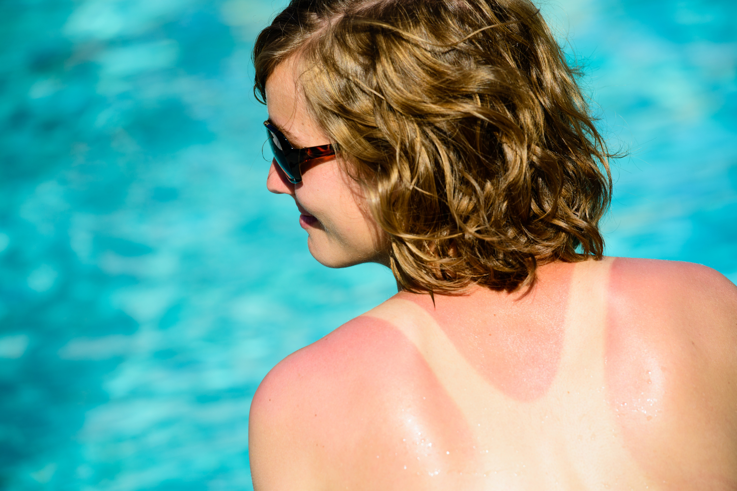 get rid of sunburn